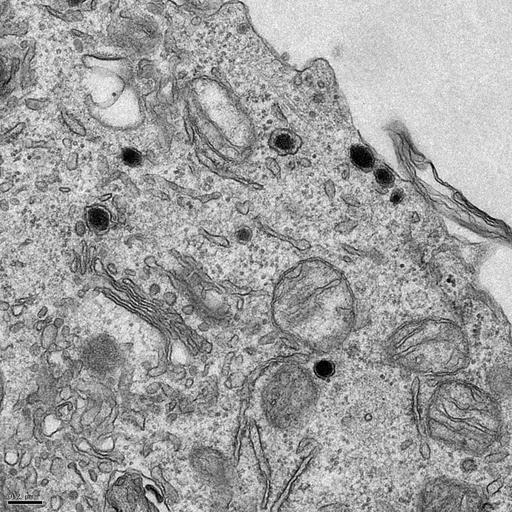 pheochromocytoma