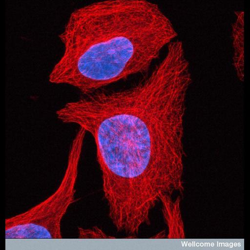 osteosarcoma