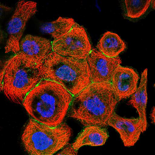 epidermoid carcinoma