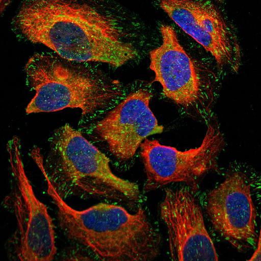 osteocarcinoma